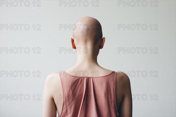Back view of bald woman with medical condition causing hair loss like Alopecia Areata or chemotherapy. KI generiert, generiert, AI generated