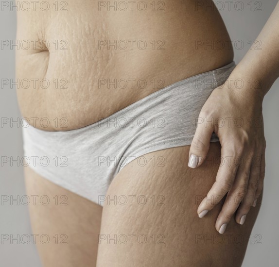 Close up woman body with stretch marks. Resolution and high quality beautiful photo