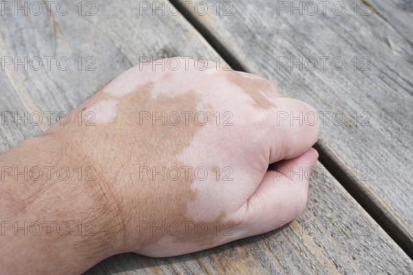 male hand with vitiligo skin condition, characterized by white unpigmented patches or blotches