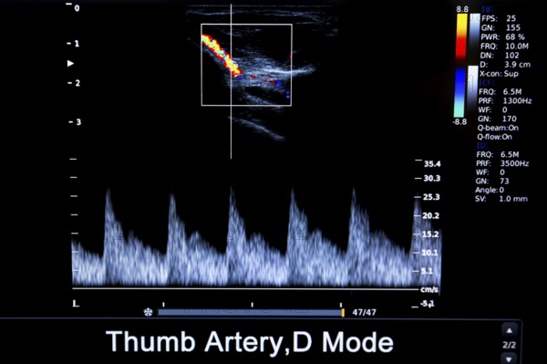 Colourful image of modern ultrasound monitor. Ultrasonography machine. High technology medical and healthcare equipment. Ultrasound imaging or sonography used in medicine. Thumb artery