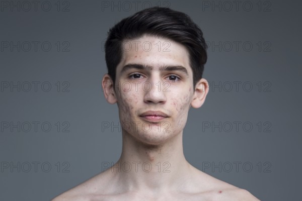 Studio portrait of a young brunette caucasian man on grey background posing. Puberty theme, problem skin, teen acne