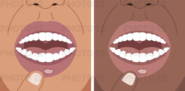 Vector illustration canker sore, aphthous ulcer on the lip, stomatitis