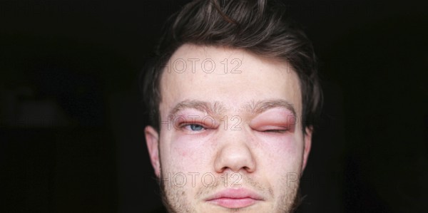 A person with a swollen eye partially closed in moderate lighting allergic reaction on the lip angioedema in a man, consequences of hyaluronic acid injections