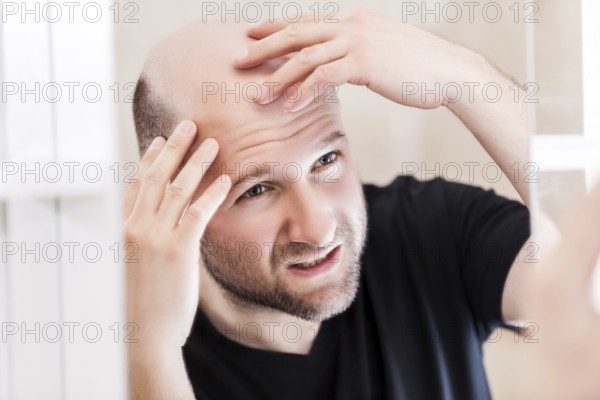 Male alopecia or hair loss concept, adult caucasian bald man looking mirror for head baldness treatment