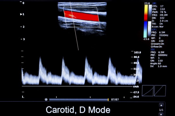 Colourful image of modern ultrasound monitor. Ultrasonography machine. High technology medical and healthcare equipment. Ultrasound imaging or sonography used in medicine. Human heart. Carodit