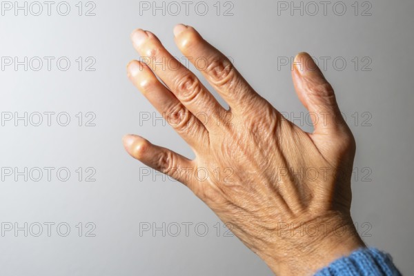 Close up view of a hand exhibiting swollen finger joints, emphasizing the painful effects of arthritis on mobility and daily life