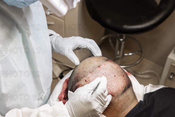 Doctor performing hair transplant. Surgeons in the operating room carry out hair transplant surgery.
