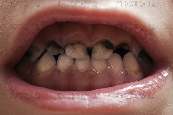 Dental medicine and healthcare, human patient open mouth showing caries teeth decay
