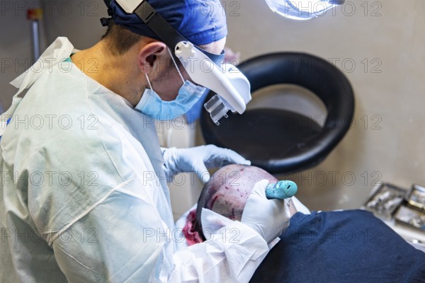Doctor performing hair transplant. Surgeons in the operating room carry out hair transplant surgery.