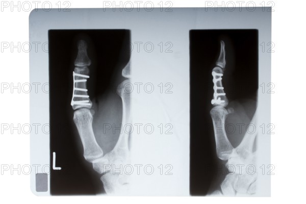 Thumb bone nailed in X-ray image