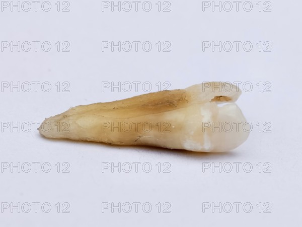 Pulled out cracked and damaged tooth, second premolar on a white background. Karaganda, Kazakhstan