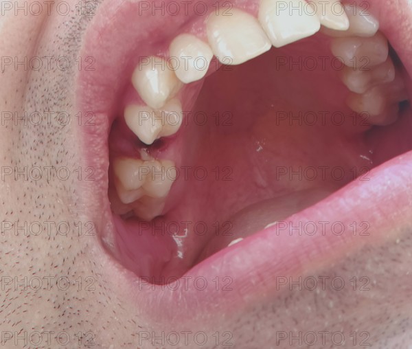 Open mouth of a man with the place of a pulled out small molar tooth, healing of a wound in the place of the tooth. Karaganda, Kazakhstan