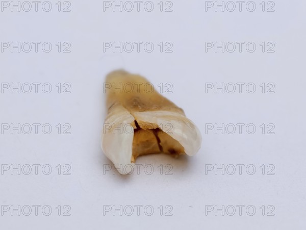 Pulled out, cracked and damaged, tooth, second premolar on a white background, Karaganda, Kazakhstan