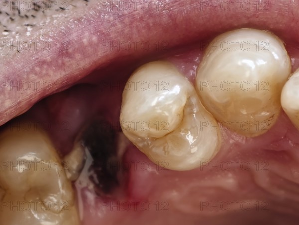 Open mouth of a man with the place of a pulled out small molar tooth, healing of a wound in the place of the tooth. Karaganda, Kazakhstan