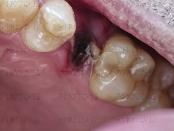 Open mouth of a man with the place of a pulled out small molar tooth, healing of a wound in the place of the tooth, Karaganda, Kazakhstan