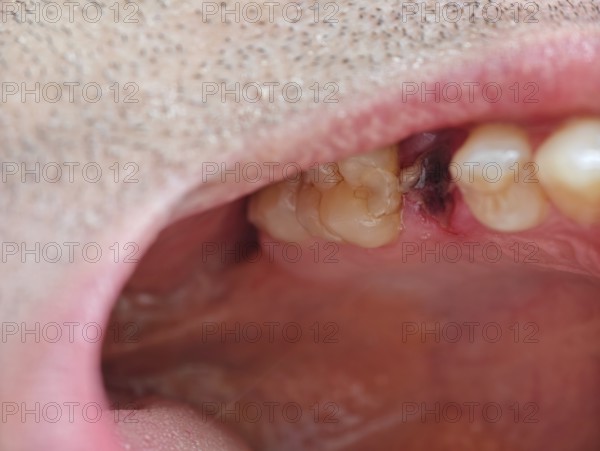 Open mouth of a man with the place of a pulled out small molar tooth, healing of a wound in the place of the tooth. Karaganda, Kazakhstan