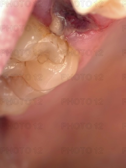 Open mouth of a man with the place of a pulled out small molar tooth, healing of a wound in the place of the tooth