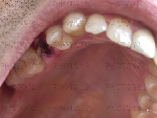 Open mouth of a man with the place of a pulled out small molar tooth, healing of a wound in the place of the tooth, Karaganda, Kazakhstan