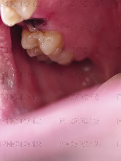 Open mouth of a man with the place of a pulled out small molar tooth, healing of a wound in the place of the tooth, Karaganda, Kazakhstan