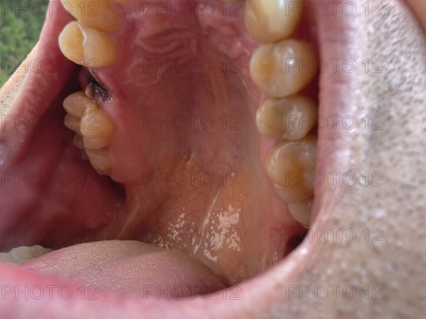 Open mouth of a man with the place of a pulled out small molar tooth, healing of a wound in the place of the tooth. Karaganda, Kazakhstan