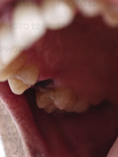 Open mouth of a man with the place of a pulled out small molar tooth, healing of a wound in the place of the tooth. Karaganda, Kazakhstan