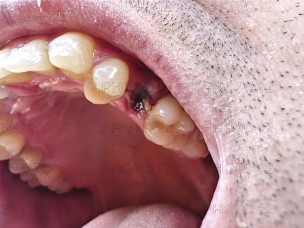 Open mouth of a man with the place of a pulled out small molar tooth, healing of a wound in the place of the tooth. Karaganda, Kazakhstan
