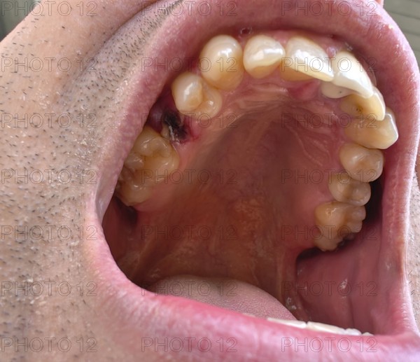 Open mouth of a man with the place of a pulled out small molar tooth, healing of a wound in the place of the tooth, Karaganda, Kazakhstan