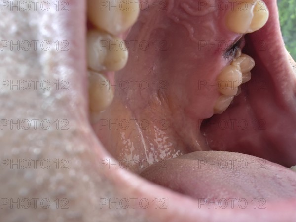 Open mouth of a man with the place of a pulled out small molar tooth, healing of a wound in the place of the tooth. Karaganda, Kazakhstan