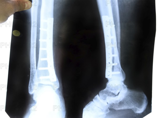 X-ray of the leg. Atyrau, Kazakhstan