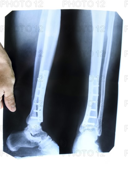 X-ray of the leg. Krasnodar, Russia