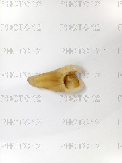 Pulled out, cracked, and damaged tooth, second premolar on a white background, Karaganda, Kazakhstan