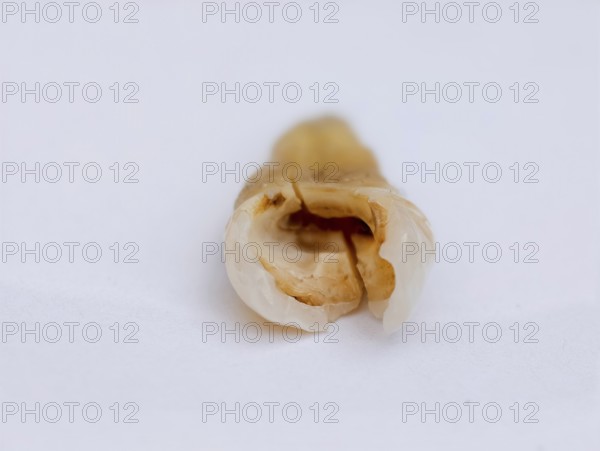 Pulled out, cracked, and damaged tooth, second premolar on a white background, Karaganda, Kazakhstan