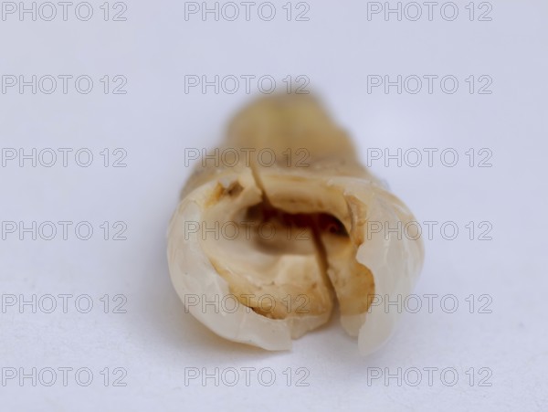 Pulled out, cracked, and damaged tooth, second premolar on a white background, Karaganda, Kazakhstan