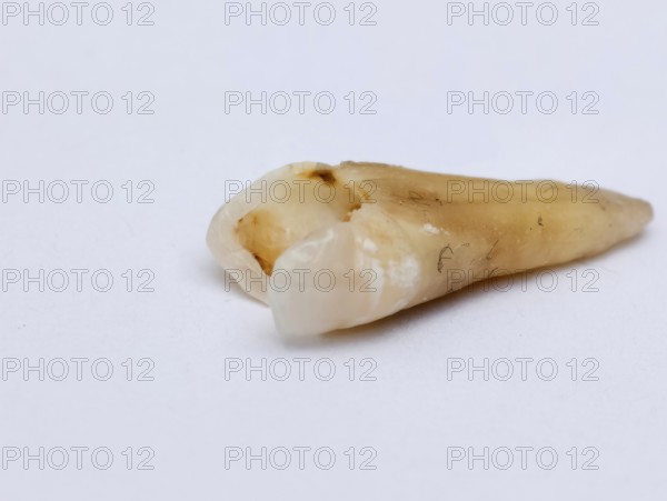 Pulled out, cracked and damaged, tooth, second premolar on a white background. Karaganda, Kazakhstan