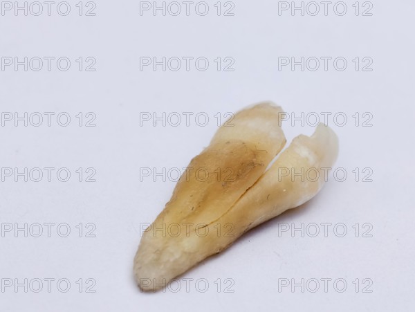 Pulled out cracked and damaged tooth, second premolar on a white background. Karaganda, Kazakhstan