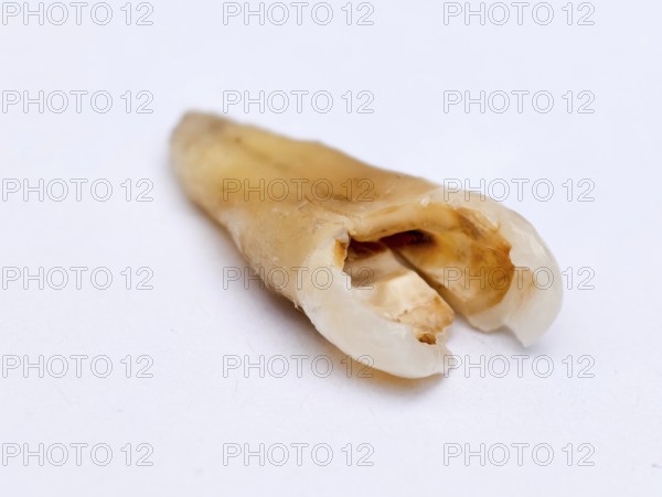 Pulled out, cracked and damaged, tooth, second premolar on a white background. Karaganda, Kazakhstan
