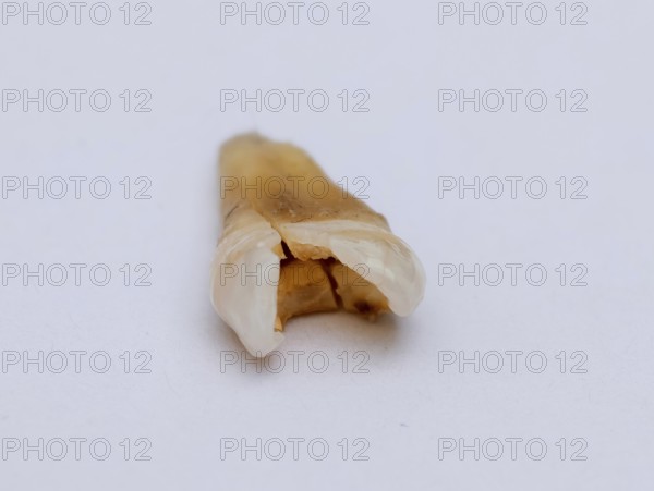 Pulled out, cracked and damaged, tooth, second premolar on a white background. Karaganda, Kazakhstan