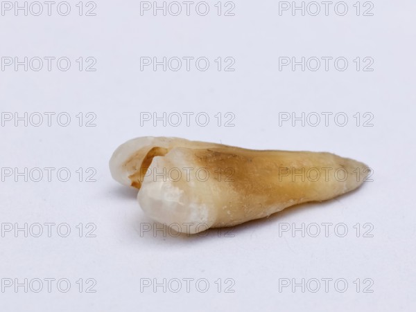 Pulled out cracked and damaged tooth, second premolar on a white background. Karaganda, Kazakhstan