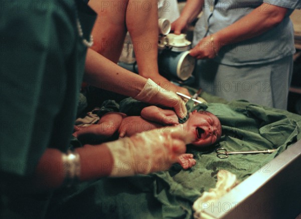 Sarajevo, BIH, 01.08.1995 -- series of 10 pictures - Maternity hospital during the civil war in 1995, newborn baby being washed. Bosnia Hercogovina, Eastern Europe