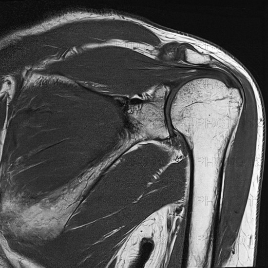 Black and white MRI of a shoulder showing the structure of bone and surrounding tissue