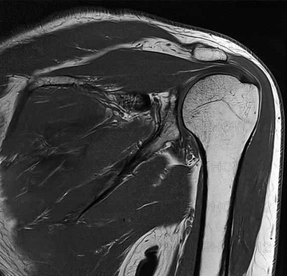 Black and white MRI of a human shoulder joint with visible bones and soft tissues