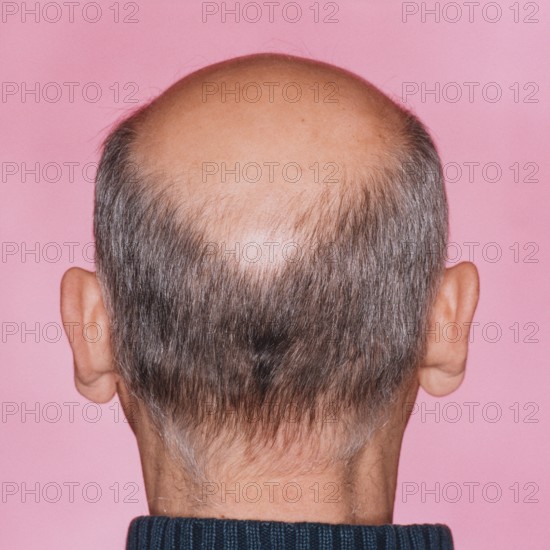 Close-up of the back of a man's head with a distinct bald head or hair loss