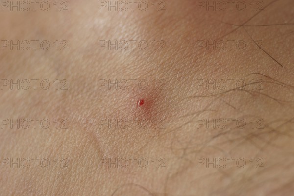 Black fly bite, skin, people, São Paulo, Brazil