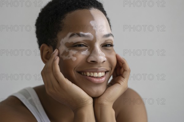 Smiling Black woman with vitiligo resting her hands near her face. Embracing beauty in diversity and skin difference. Generative ai, AI generated