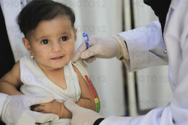A doctor examines children's malnutrition inside a refugee camp. Malnutrition was measured using a mid-upper arm circumference belt. Aleppo, Syria October 29, 2022, Aleppo, Syria