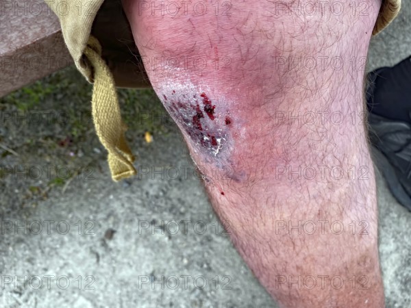 Close-up of injured knee with skin abrasion and wound, fall, bike travel, Scotland, United Kingdom