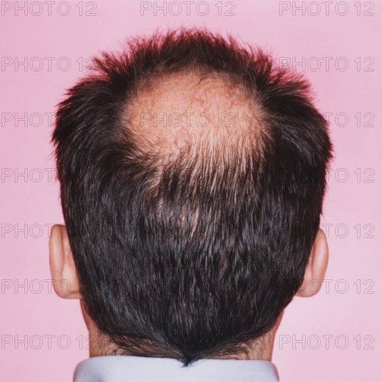Close-up of the back of a man's head with a distinct bald head or hair loss
