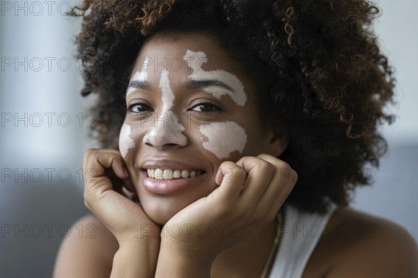 Beautiful smiling Black woman with vitiligo resting her hands near her face. Embracing beauty in diversity and skin difference. Generative ai, AI generated