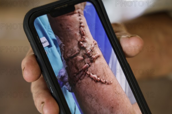 Close-up of a healed scar from a crocodile attack on a smartphone, Adelaide River, Northern Territory, Australia