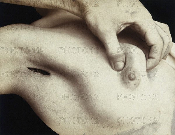 Patient, surgery, breast surgery, lump removal, tumor, metal surgical instrument inserted through an incision in the armpit. medicine, history of medicine, photography, turn of the century around 1900, historical